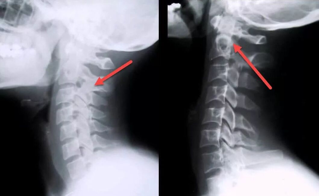 Diagnostic de l'ostéochondrose cervicale