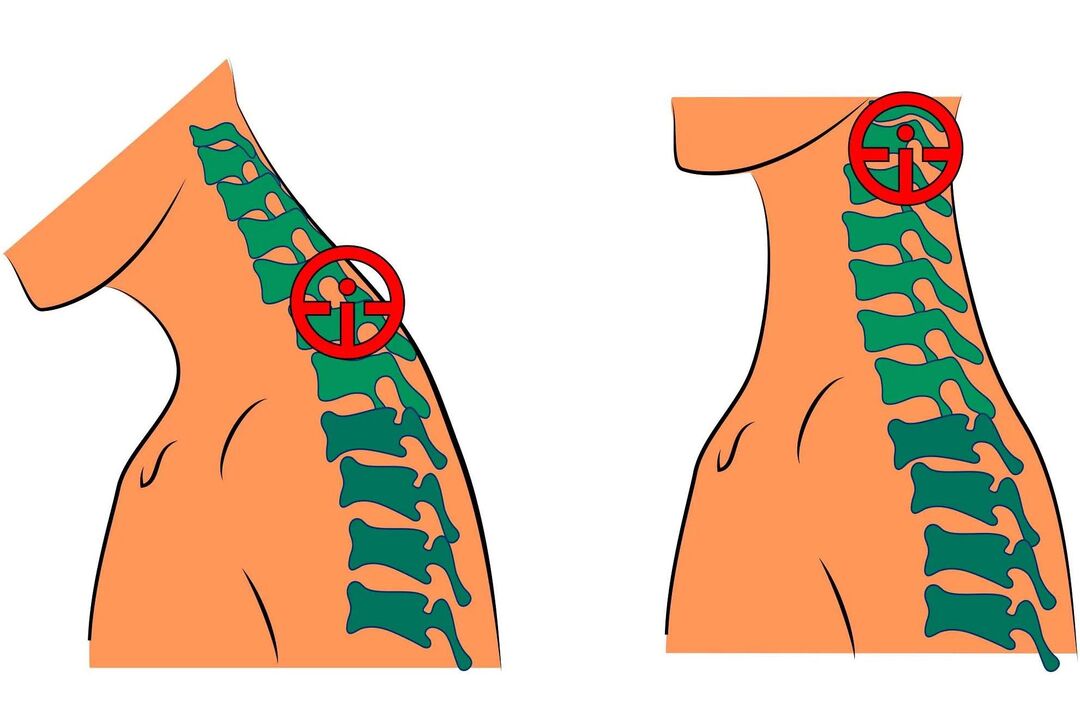 ostéochondrose cervicale