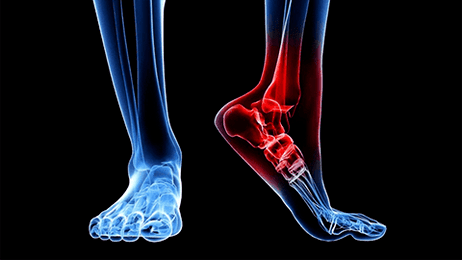 Arthrose de l'articulation de la cheville