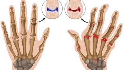 Les principales différences entre l'arthrite et l'arthrose