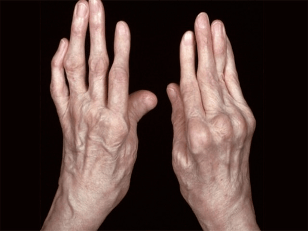 Arthrite comme cause de douleur dans les articulations des doigts