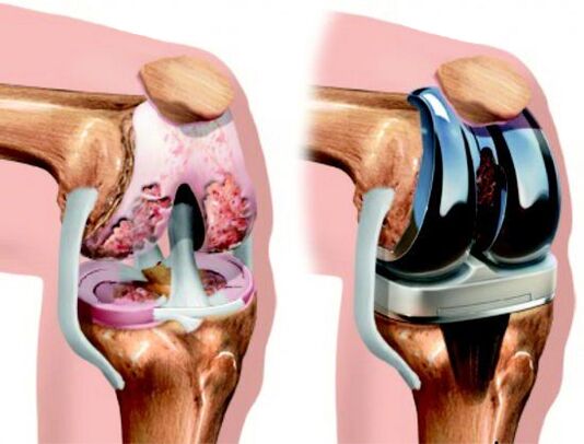 Le remplacement d'endoprothèse est une méthode de traitement chirurgical dans laquelle l'articulation affectée est remplacée par une prothèse.