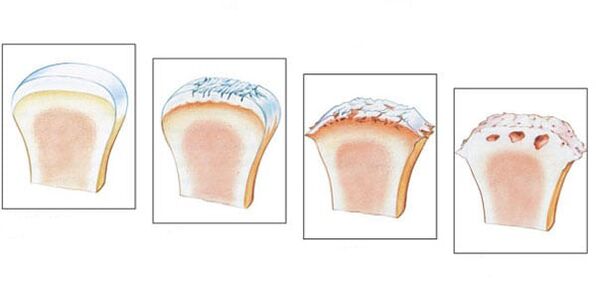 Articulation saine et 3 degrés de développement de l'arthrose