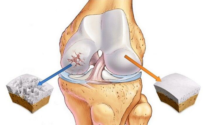 Articulations saines et arthritiques