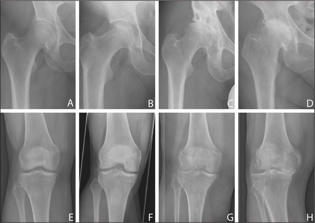 Stades de développement de l'arthrose articulaire sur l'image radiographique