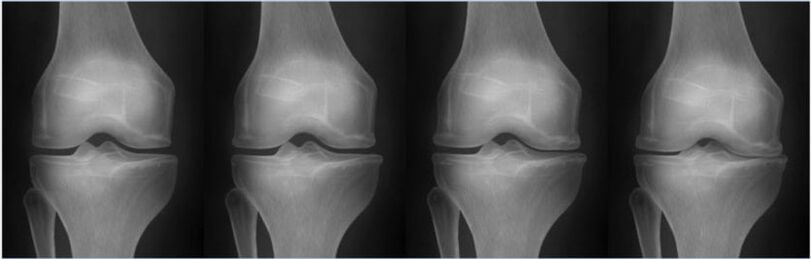 Stades de l'arthrose selon la classification de Kellgren-Lawrence