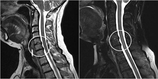IRM du rachis cervical avec signes d'ostéochondrose